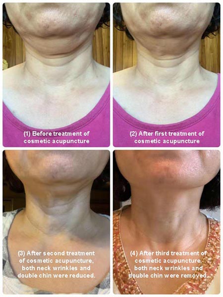 Removal of Neck Wrinkles and Double Chin