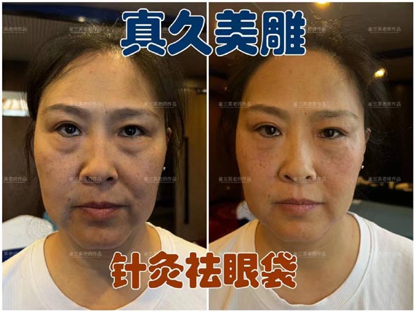 Eye Bag Removal with Authentic Cosmetic Acupuncture