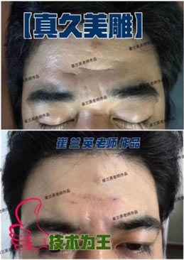 Skin Rejuvenation with Authentic Cosmetic Acupuncture